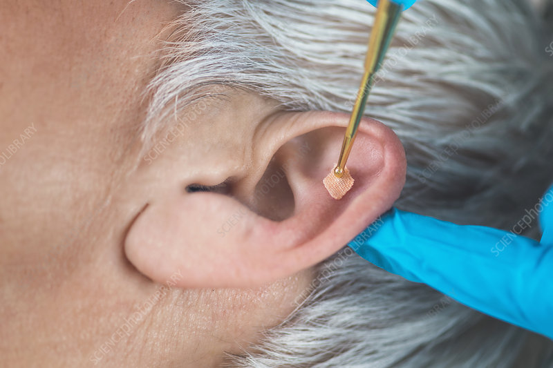 Auricular therapy
